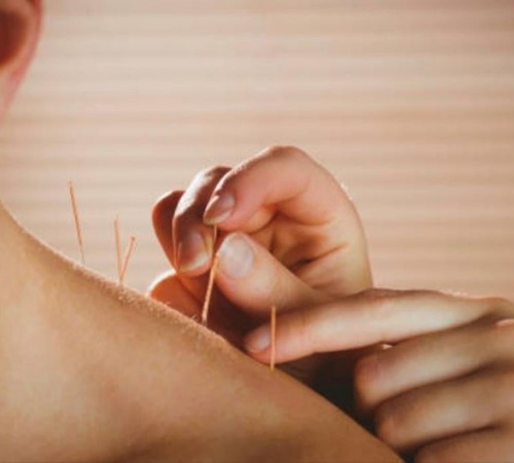 Dry Needling /…